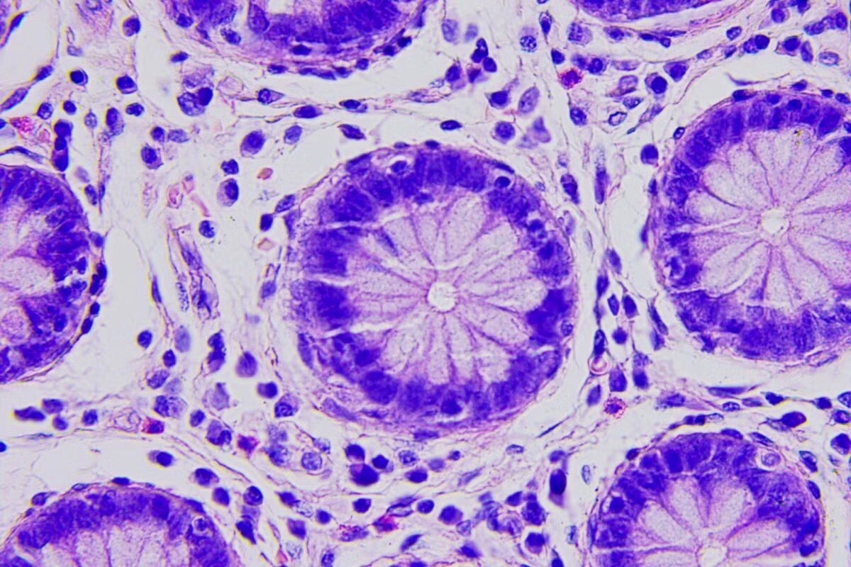 Colon cancer cells under a microscope